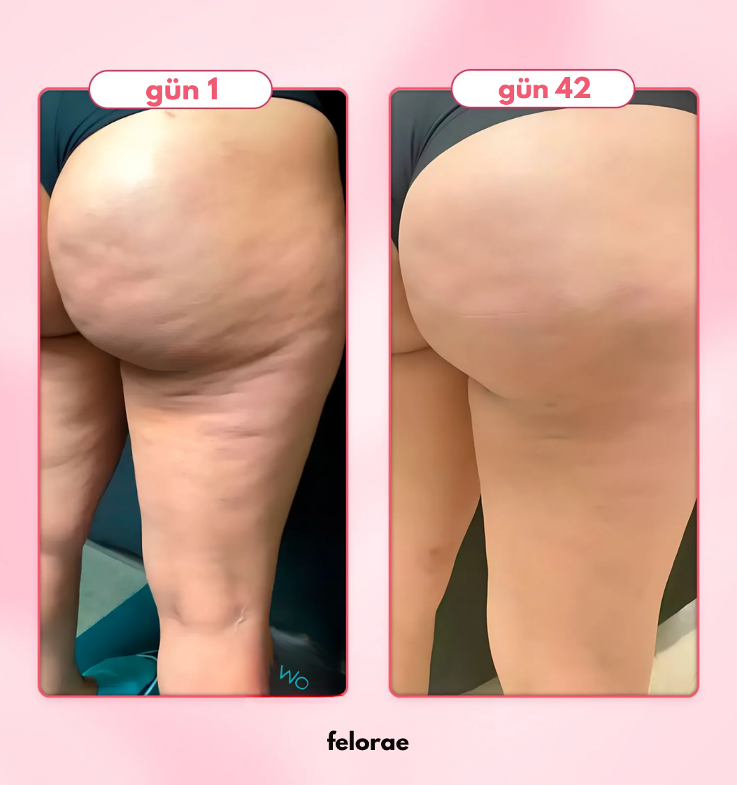 Felorae™ Selülit Masaj Aleti